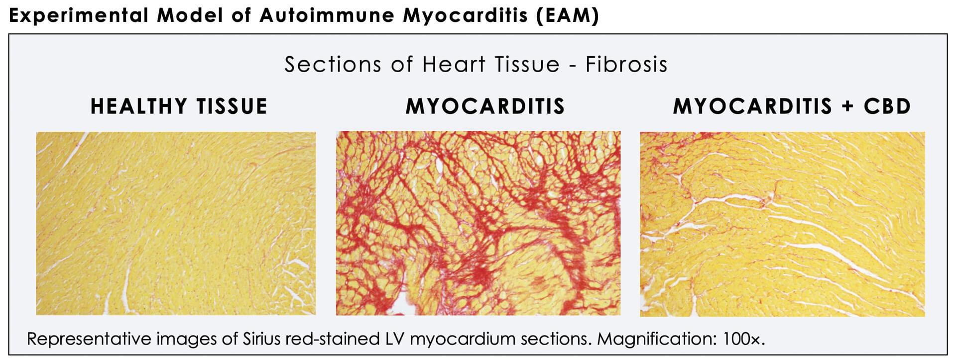 myocarditis